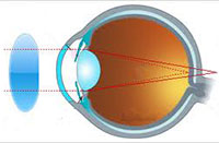 причина дальнозоркости